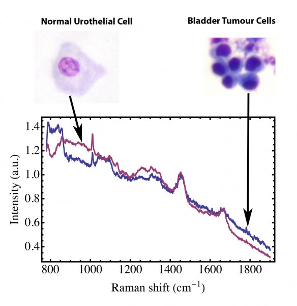 Figure 3 Raman spectrum of normal human urothelial cells (–––––) and malignant bladder tumour cells (–––––) collected from a urine sample