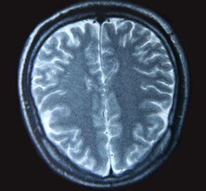 A magnetic resonance imaging scan of the human brain