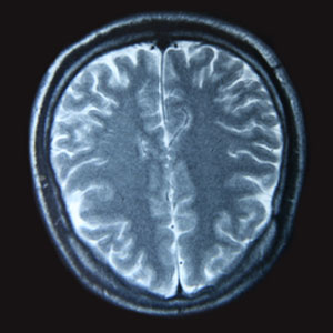 A magnetic resonance imaging scan of the human brain