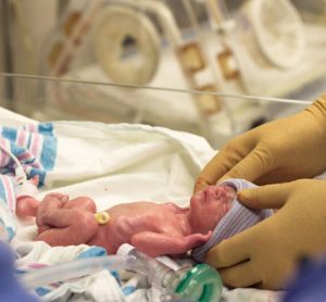 A premature newborn just after a c-section is cleaned up and prepped for the incubator shown in the background.