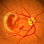 Age-related macular degeneration