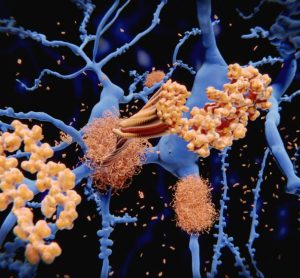 Stem-cell therapy Lomecel-B delivers potential in Alzheimer’s