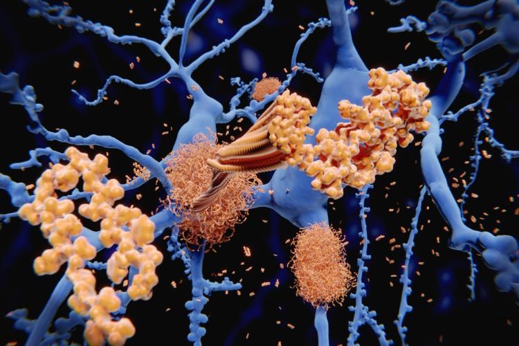 Stem-cell therapy Lomecel-B delivers potential in Alzheimer’s