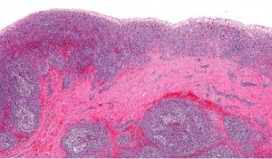 Atezolizumab