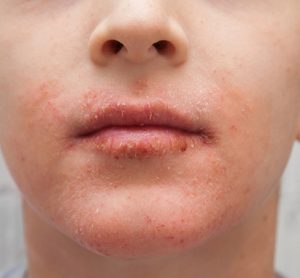 Boy with atopic dermatitis