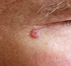 close up of a reddened, small oval lump (basal cell carcinoma) next to someone's eye