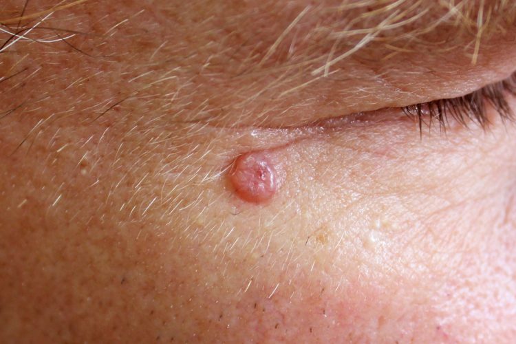 close up of a reddened, small oval lump (basal cell carcinoma) next to someone's eye