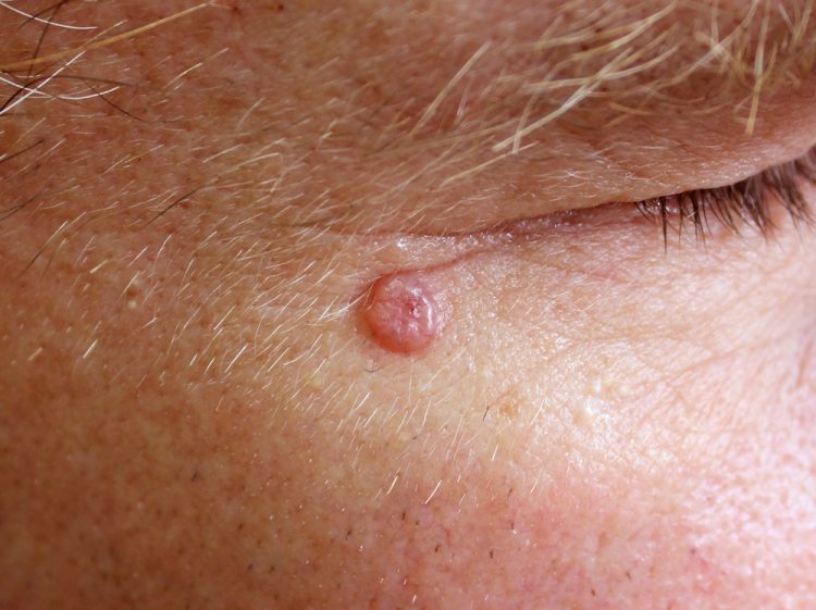 close up of a reddened, small oval lump (basal cell carcinoma) next to someone's eye