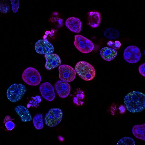 Human colorectal cancer cells treated with a topoisomerase inhibitor and an inhibitor of the protein kinase ATR (ataxia telangiectasia and Rad3 related), a drug combination under study as a cancer therapy. Cell nuclei are stained blue; the chromosomal protein histone gamma‑H2AX marks DNA damage in red and foci of DNA replication in green. Created by Yves Pommier, Rozenn Josse, 2014.