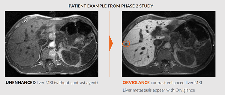 Figure 1: MRI images showing ability of Orviglance to aid detection of liver metastasis compared with unenhanced MRI.