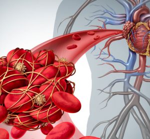 Blood clot deep vein thrombosis Venous thromboembolism pulmonary embolism