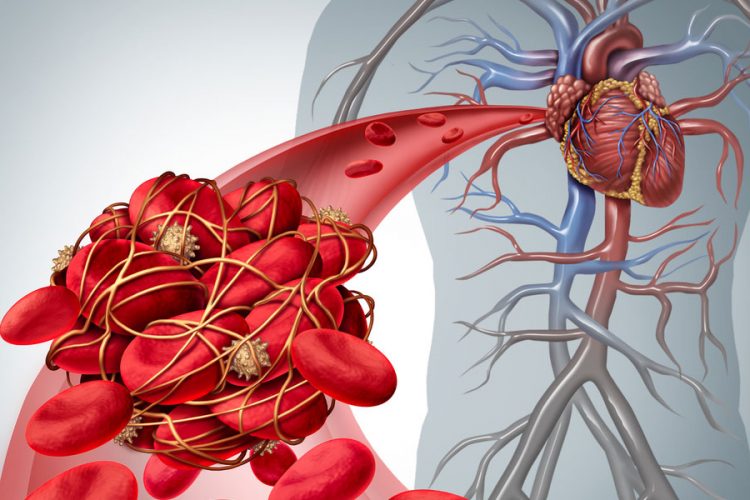 Blood clot deep vein thrombosis Venous thromboembolism pulmonary embolism