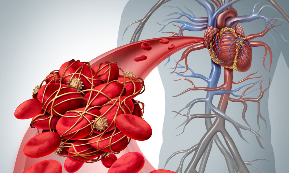 Blood clot deep vein thrombosis Venous thromboembolism pulmonary embolism