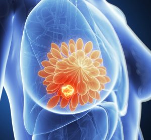 3d rendered illustration of breast cancer (close up of the anatomy of a breast with a glowing orange ball of cells inside representing a tumour)