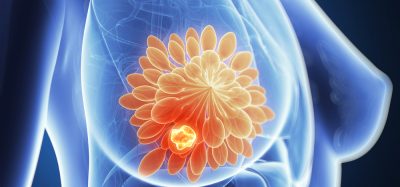 3d rendered illustration of breast cancer (close up of the anatomy of a breast with a glowing orange ball of cells inside representing a tumour)