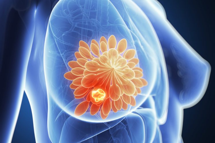 3d rendered illustration of breast cancer (close up of the anatomy of a breast with a glowing orange ball of cells inside representing a tumour)