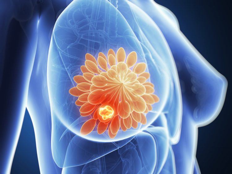 3d rendered illustration of breast cancer (close up of the anatomy of a breast with a glowing orange ball of cells inside representing a tumour)