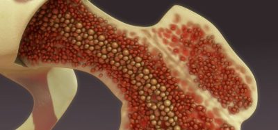 CAR T-cell therapy offers substantial remission rates in multiple-myeloma trial