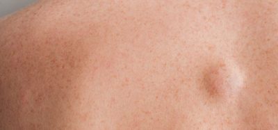 Small molecule drug CBL-514 shows promise in rare disease - Dercum's-disease