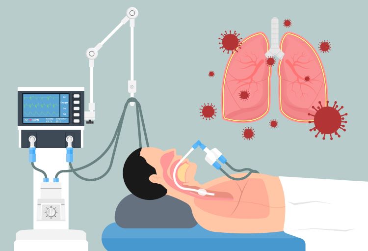 Acute respiratory distress syndrome (ARDS) concept - cartoon of patient in hospital bed intubated and on breathing machine due to respiratory failure/distress