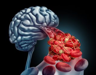 3D illustration of a ball of red and other blood cell types blocking an artery in a cutaway from a brain - idea of cavernous sinus thrombosis (CVST)