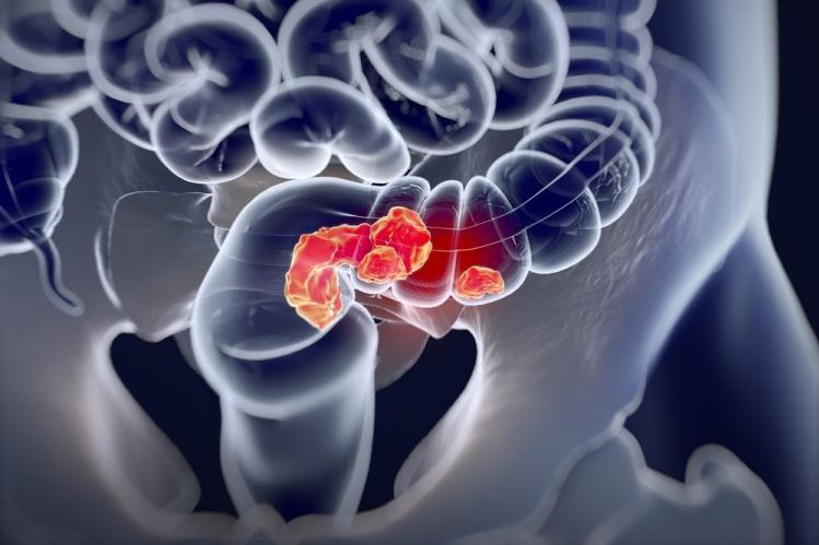 close up 3D illustration of glowing red colorectal tumours within the gastrointestinal tract - idea of colorectal cancer