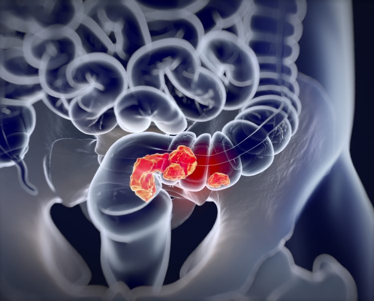 close up 3D illustration of glowing red colorectal tumours within the gastrointestinal tract - idea of colorectal cancer