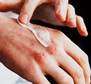 Hoth Therapeutics HT-001 cancer