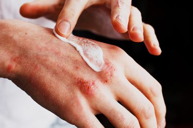 close up of a person spreading a topical cream over inflamed skin affected by atopic dermatitis on their hand