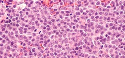 Bispecific antibody European approval for DLBCL