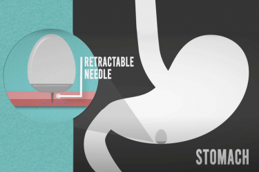 Diagrammatic representation of the new pill delivery system, which can inject large quantities of monoclonal antibodies and other drugs into the lining of the stomach after being swallowed [Credit: Giovanni Traverso].