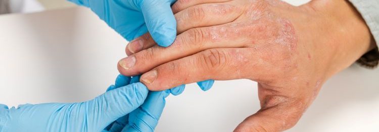 Could Eli Lilly deliver first-line atopic dermatitis treatment?