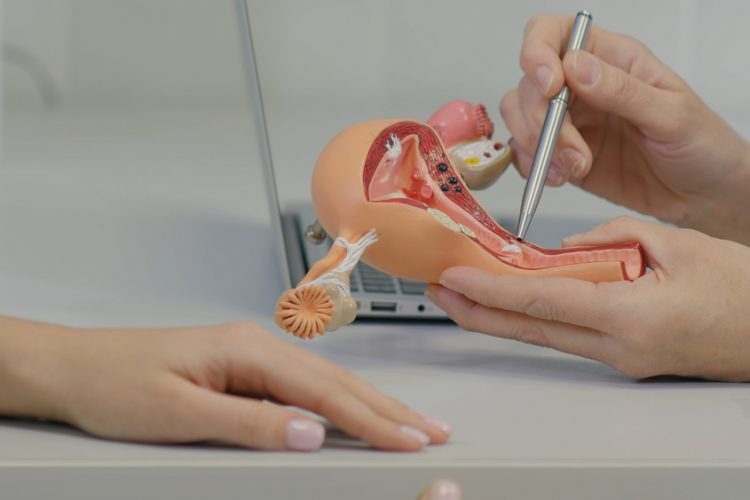 Gynecologist doctor consulting patient using uterus anatomy model