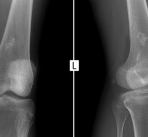Ewing-sarcoma-xray-knee-scan