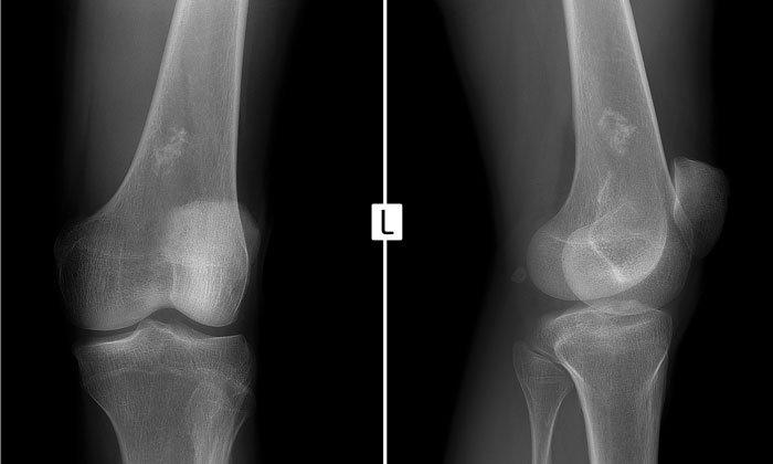 Ewing-sarcoma-xray-knee-scan