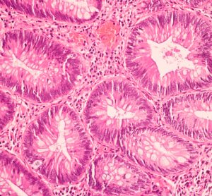 600x magnified view of ductal cell carcinoma stained with haematoxylin & eosin (H&E)