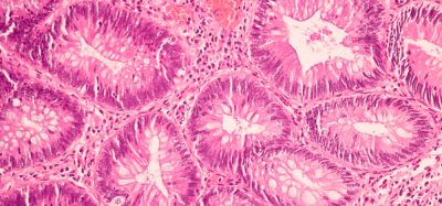 600x magnified view of ductal cell carcinoma stained with haematoxylin & eosin (H&E)