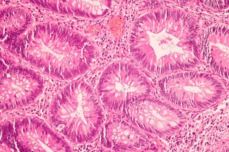 600x magnified view of ductal cell carcinoma stained with haematoxylin & eosin (H&E)