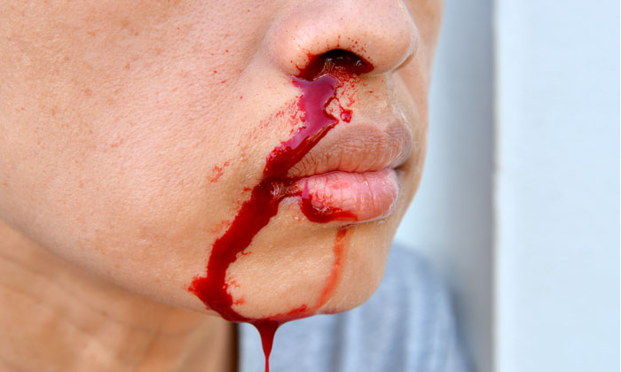 HHT-nose-bleed-patient