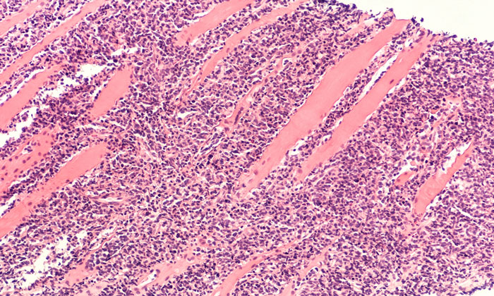 Hodgkin lymphoma immune system