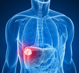 Dual immunotherapy approved for US liver cancer patients