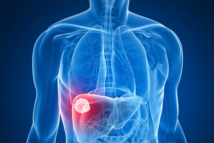 Dual immunotherapy approved for US liver cancer patients