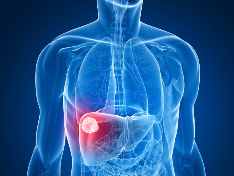 Dual immunotherapy approved for US liver cancer patients