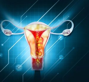 New immuno-oncology treatment Jemperli plus chemotherapy approved for endometrial cancer