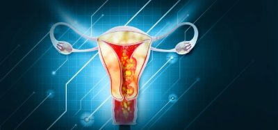 New immuno-oncology treatment Jemperli plus chemotherapy approved for endometrial cancer