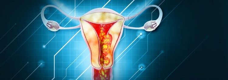 New immuno-oncology treatment Jemperli plus chemotherapy approved for endometrial cancer