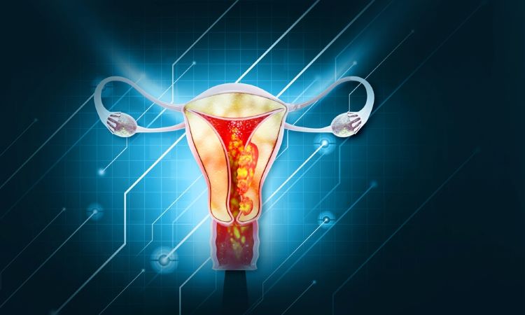 New immuno-oncology treatment Jemperli plus chemotherapy approved for endometrial cancer