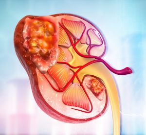 Cartoon of a diseased kidney - idea of kidney cancer