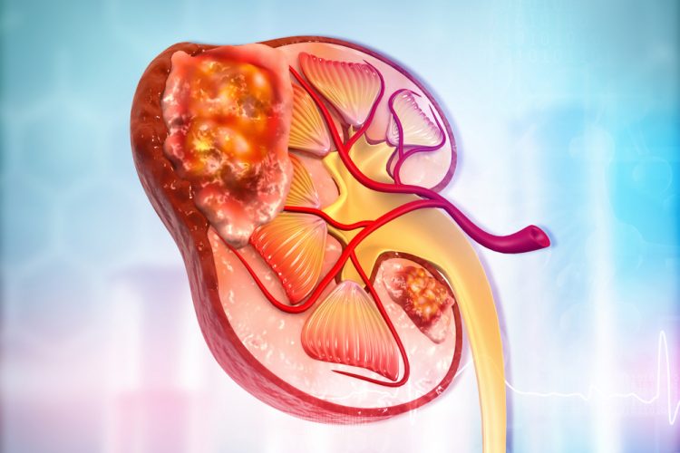 Cartoon of a diseased kidney - idea of kidney cancer