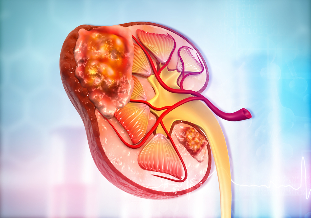 Cartoon of a diseased kidney - idea of kidney cancer